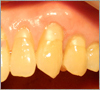歯肉移植による歯肉整形